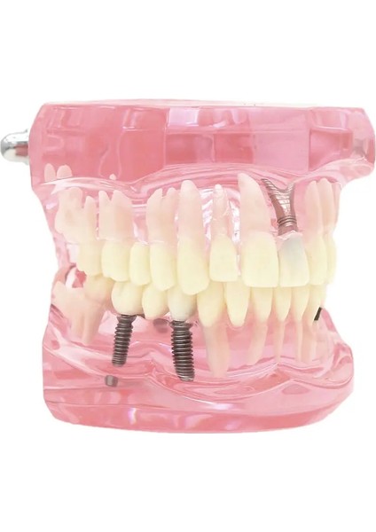 Diş Diş Modeli Öğretme Çalışması Oral Implant Restorasyonu ve Patoloji Pembe (Yurt Dışından)