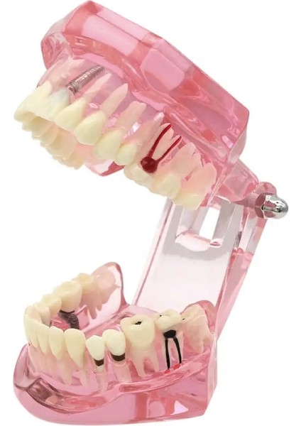 Diş Diş Modeli Öğretme Çalışması Oral Implant Restorasyonu ve Patoloji Pembe (Yurt Dışından) modelleri
