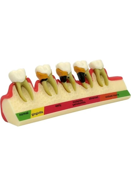 M4010 Tarzı Diş Patolojik Typodont Diş Modeli Periodontoloji Implant Endodontik Çürük Tedavisi Typodont Modeli Yetişkin Çocuk Diş (Yurt Dışından)