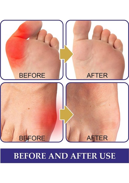 Adet Eklemler Bunyon Giderici Yama Güvenli Sağlıklı Anti Bunyon Yama Doğal Rahatsızlığı Rahatlatmak Vücut Tedavisi Için Dolaşımını Teşvik Edin (Yurt Dışından) indirimleri