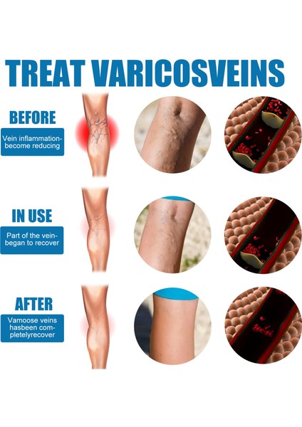 30 ml Rahat Varisli Damar Venöz Masaj Sprey Aktive Edici Sprey Pürüzsüz Bacak Kan Damarı Şişme Vücut Bakımını Rahatlatır (Yurt Dışından) indirimleri