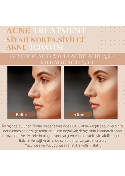 Orıgınal Hand Made Antı Acne Skın And Body Soap - El Yapımı Akne Karşıtı Cilt ve Vücut Sabunu 120 gr indirimleri