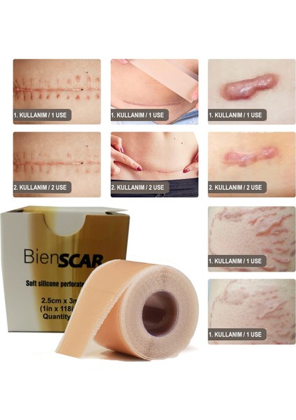 Soft Silikon Bant - Dikiş Izi - Sezaryen - Yanık - Estetik 2cm X 3mt indirimleri