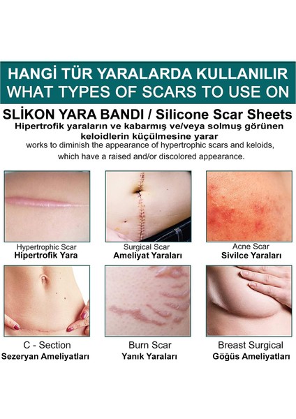 Soft Silikon Bant - Dikiş Izi - Sezaryen - Yanık - Estetik 2cm X 3mt fiyatları