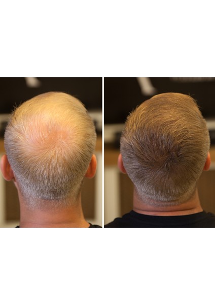 Fıxplant Saç Dolgunlaştırıcı 3 Şişe Topik 84 Gr. | Seyrek Saçlar Için Saç Tozu | Saç Fiberi fırsatları