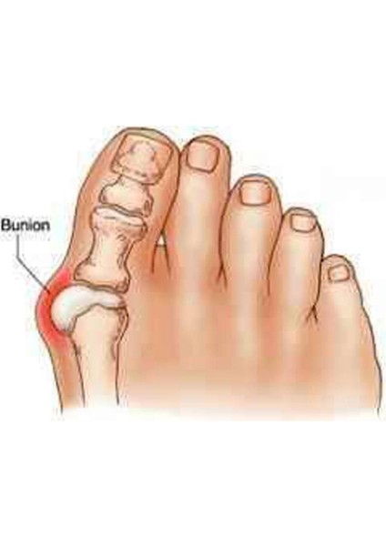 Silikon Orta Parmağa Geçen Metatarsal Pad