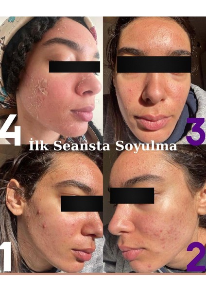 Yosun Peeling 30 Kullanım