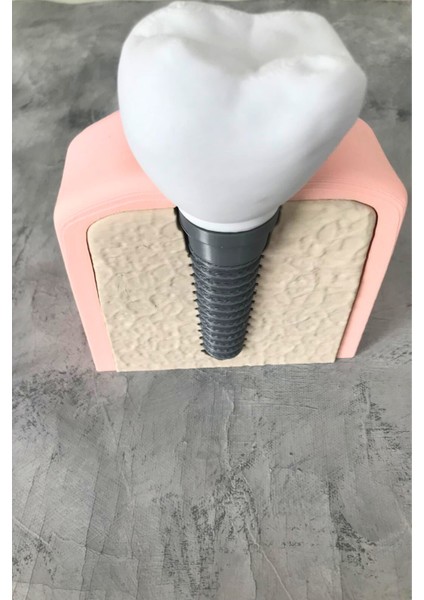 Diş Implantı Çıkarılabilir Uygulama Öğretim Yardımcısı Maket / Dental Implant Model