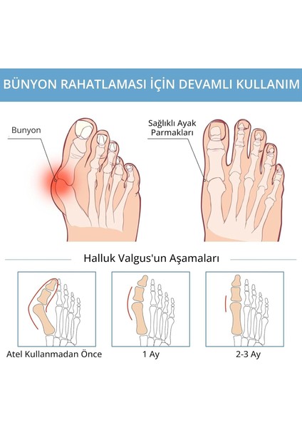 Ayak Ateli Ayak Baş Parmak Gece Ateli - Kemik Çıkıntısı Koruyucu x 2 adet