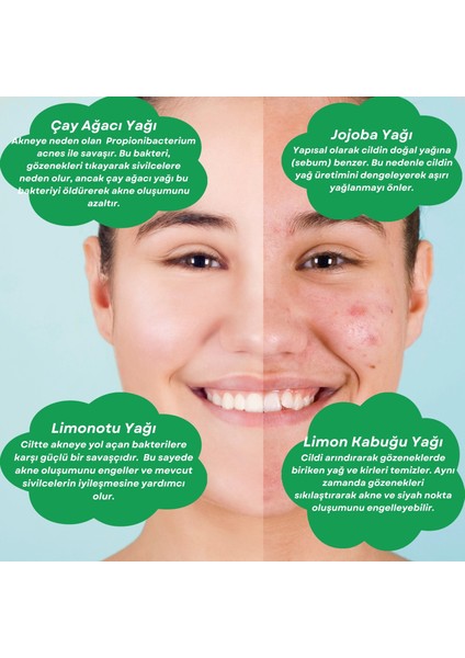 Antı-Acne Care Oıl Akne Karşıtı Cilt Bakım Yağı fırsatları