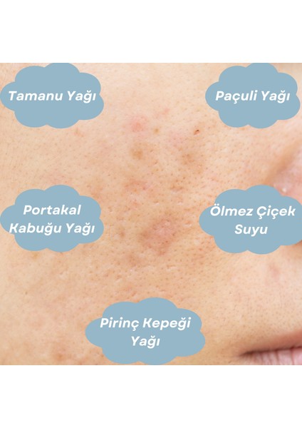 Antı-Blemısh Serum Leke Giderici Cilt Bakım Serumu fırsatları