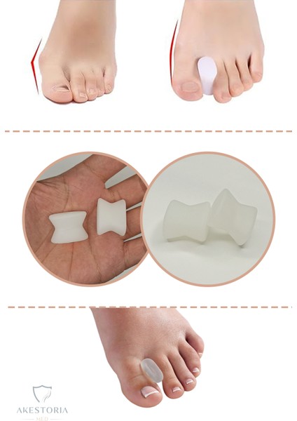 Çift Ayak Parmak Arası Makara - Baş Parmak Şekil Düzeltici