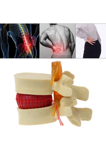 Lomber Omurga Modeli Anatomik Bel Disk Fıtığı Anatomi Tıp Eğitim Aracı (Yurt Dışından)