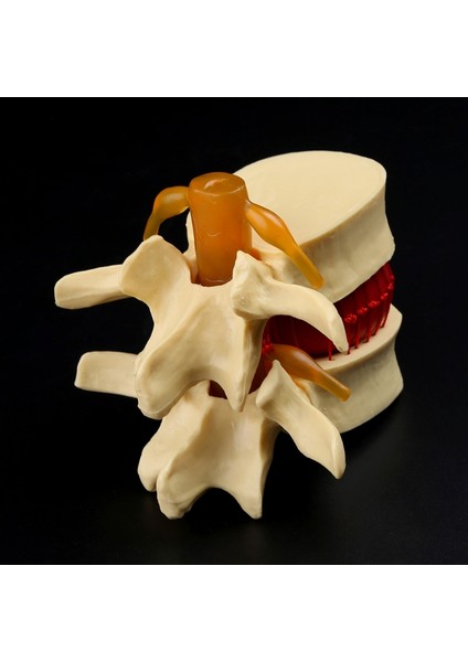 Anatomik Bel Omur Disk Herniasyon Anatomi Eğitim Aracı (Yurt Dışından)