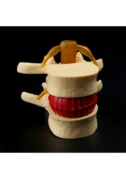 Anatomik Bel Omur Disk Herniasyon Anatomi Eğitim Aracı (Yurt Dışından)