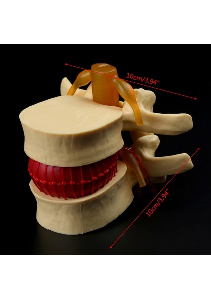 Anatomik Bel Omur Disk Herniasyon Anatomi Eğitim Aracı (Yurt Dışından)