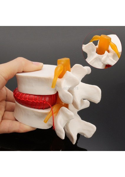 Diş 1:1 Insan Anatomi Iskeleti Lomber Disk Herniasyon Öğretim Modeli (Yurt Dışından)