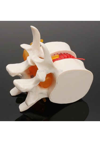 Diş 1:1 Insan Anatomi Iskeleti Lomber Disk Herniasyon Öğretim Modeli (Yurt Dışından)