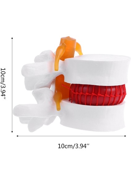 Insan Anatomik Lomber Disk Herniasyon Modeli Tıbbi Eğitim Yardım Anatomi Enstrümanı (Yurt Dışından)