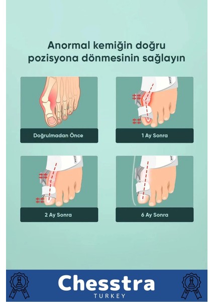 Yumuşak Yıkanabilir Bedensiz Koruma Aparat Sağ Sol Ayak Uyumlu Baş Parmak Kemik Düzeltici 6 Adet fiyatları