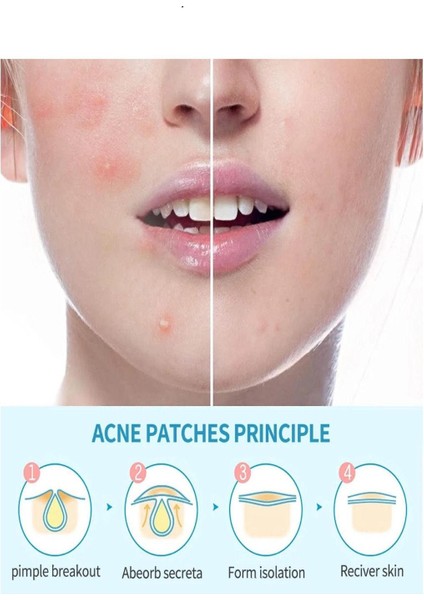 Akne Pimple Temizleme Bandı - Acne Pimple Patch
