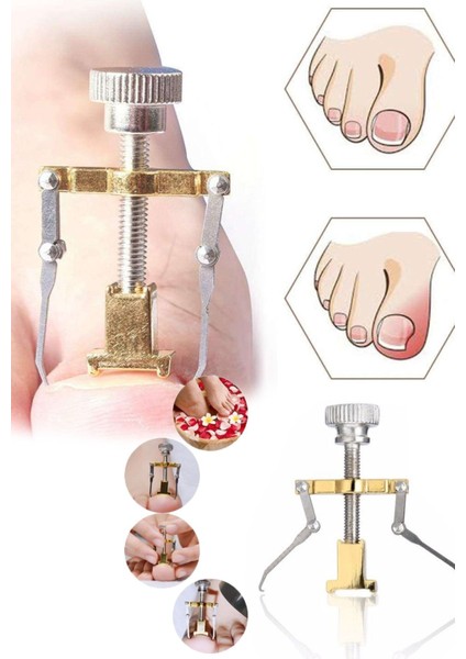 Batık Tırnak Düzeltme Aparatı Batan Tırnak Düzeltme Aleti Düzeltme Aleti