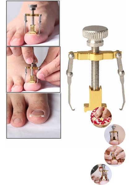 Batık Tırnak Çıkartıcı Ayak Tırnak Düzeltici Pens Aparat fırsatları