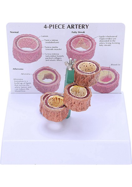 3x Ateroskleroz Tromboz Modeli Damar Hastalığı Gösterimi Kalp Vasküler Patoloji Modeli (Yurt Dışından)