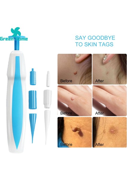 Green Home Cilt Etiketi Sökücü Uygun Köstebek Cilt Etiketi Sökücü Aracı Kaldırmak (Yurt Dışından) indirimleri