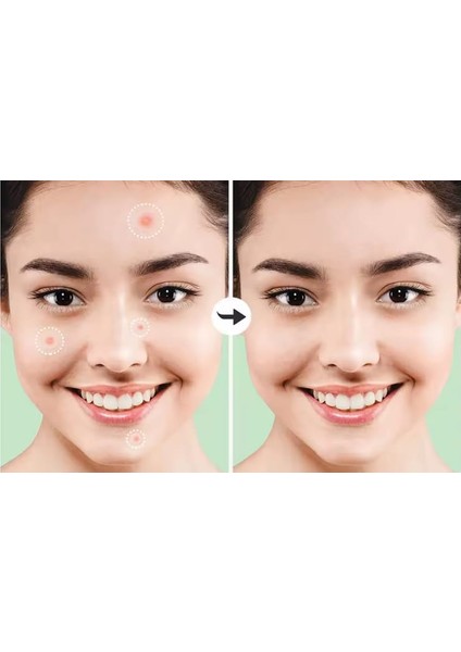 48 Adet Bant Hidrokolloid, Pimple Patch Hydrocollaid