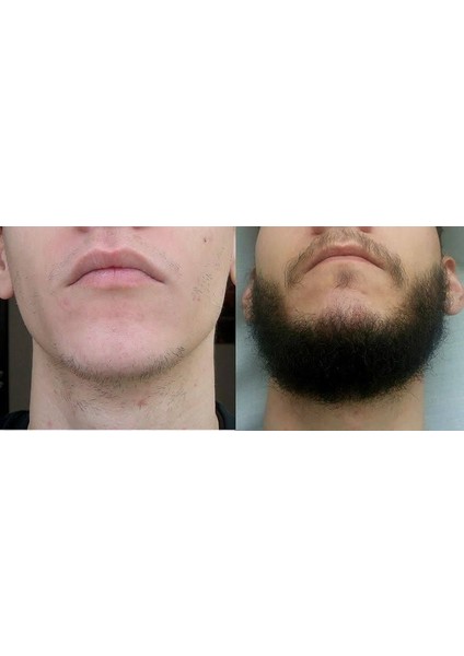 Sakal Çıkarıcı Serum + Dermaroller indirimleri