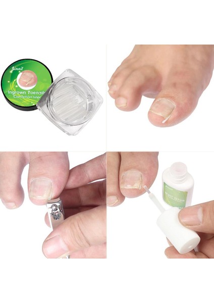 Tırnak Bakımı Kanca Dosya Temizleme Aracı 1 Takım Esnek Pedikür Araçları Batık Ayak Tırnak Düzeltme Elastik Yamalar Pedi (Yurt Dışından)