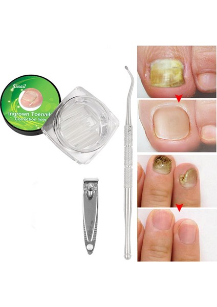 Tırnak Bakımı Kanca Dosya Temizleme Aracı 1 Takım Esnek Pedikür Araçları Batık Ayak Tırnak Düzeltme Elastik Yamalar Pedi (Yurt Dışından) modelleri