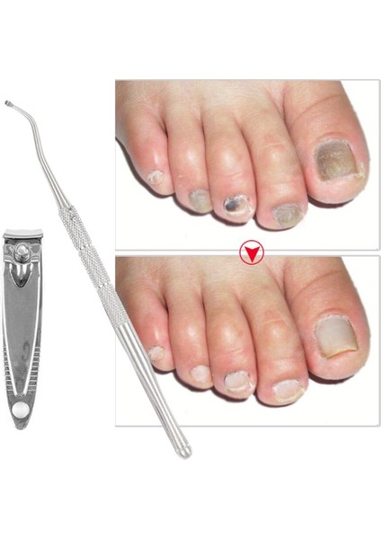Tırnak Bakımı Kanca Dosya Temizleme Aracı 1 Takım Esnek Pedikür Araçları Batık Ayak Tırnak Düzeltme Elastik Yamalar Pedi (Yurt Dışından) indirimleri