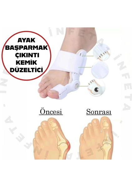 Baş Parmak Kemik Düzeltici Gece Ateli Düzeltici Ayak Başparmak Kemik Çıkıntısı Düzenleyici Aparat