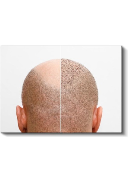 Saç Ekimi Uzmanı - Yeni Başlangıç Kanvas Tablo fiyatları