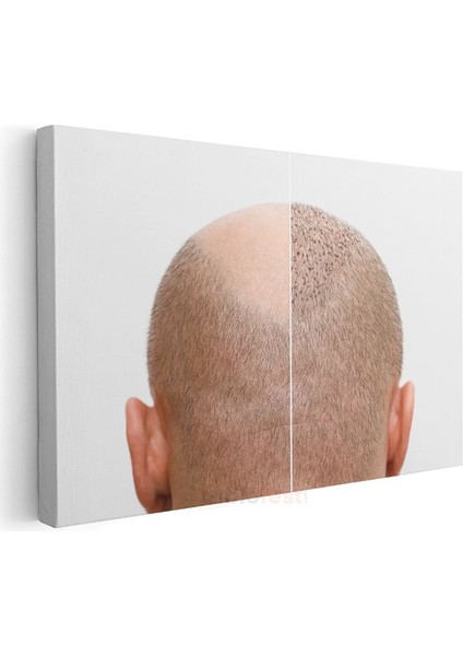 Saç Ekimi Uzmanı - Yeni Başlangıç Kanvas Tablo modelleri