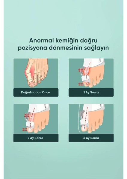 2 Adet Gece Ateli Ayak Baş Parmak Ayak Baş Parmağı Koruma Düzeltici Aparat
