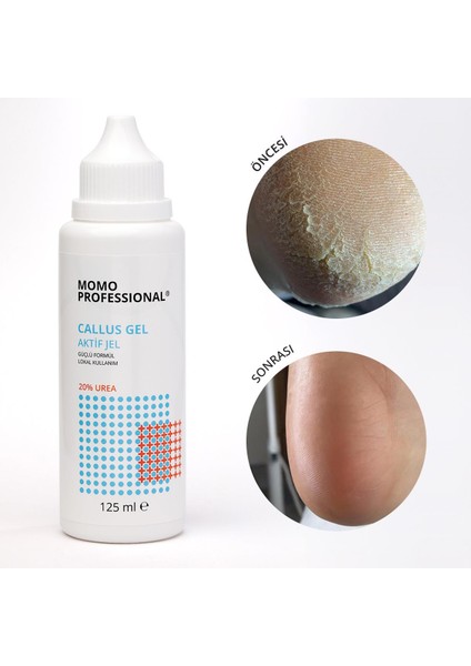 Callus Gel, Nasır Çıkarıcı Jel, Pedikür için Keratolitik Jel, 125 ml