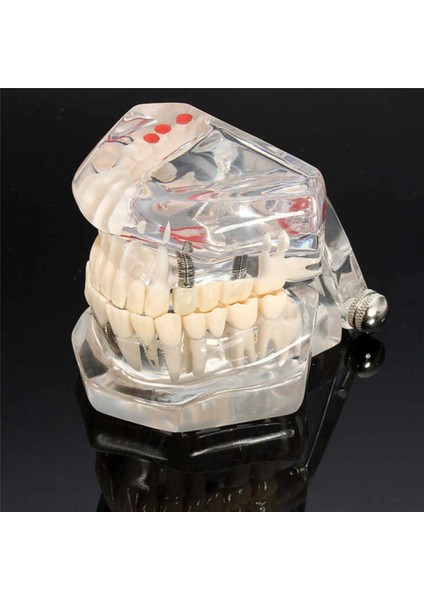 Diş Kliniği Için, Diş Implant Hastalığı Diş Modeli ile Restorasyon Köprü Malocclusion