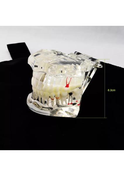 Diş Kliniği Için, Diş Implant Hastalığı Diş Modeli ile Restorasyon Köprü Malocclusion