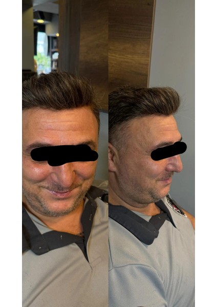 Protez Saç New Ancora 6X10 Koyu Kahve,ınce Telli Her Yöne Taranabilen Alt Yapı %100 Insan Saçı