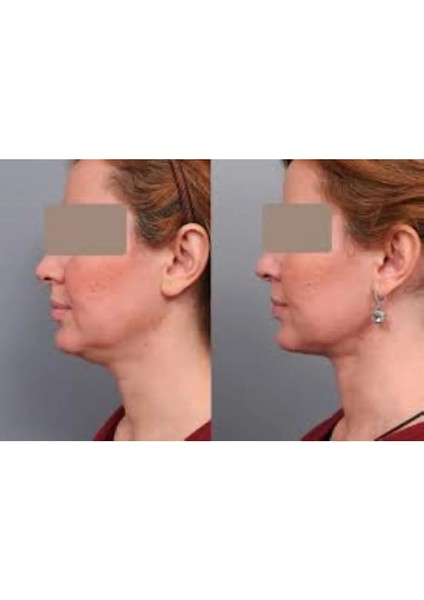 Dr Lipo Mezoterapi Gıdı Eritme, Yanak Inceltme [1 Flakon 5ml Fiyatıdır]