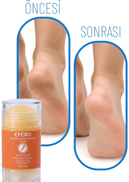 Kuru ve Yıpranmış Ayaklar & Topuklar Için Ayak ve Topuk Kremi 40G