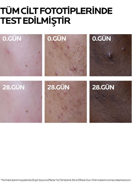 La Roche Posay Effaclar Duo + Cilt Kusuru Görünümü Karşıtı Akneye Eğilim Gösteren Ciltler Için Bakım Kremi 40 ml 2 Adet