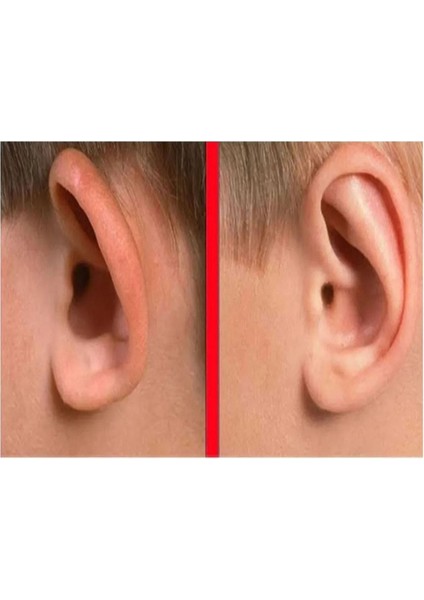 Şeffaf Çift Taraflı Kulak Düzeltme Bandı, Çocuk ve Yetişkinler İçin Konforlu Kullanım