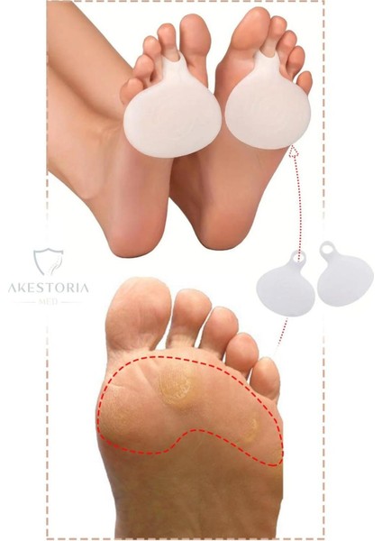 Çift Orta Parmak Metatarsal Silikon Pedi Yastığı, Nasır Koruma ve Rahatlık Sağlar