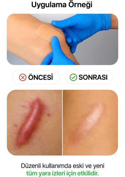 Skar Giderici Silikon Şerit Keloid Sezaryen Cilt Çatlakları Bbl Ameliyat Izi 1'li indirimleri