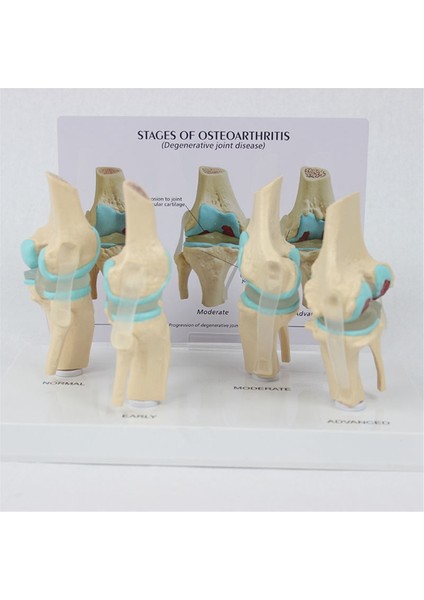 Osteoartrit Anatomi Modeli Eğitim Anahtar Kartı ile 4 Aşama (Yurt Dışından) fiyatları
