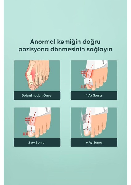 Ayak Parmak Ateli, Kemik Düzeltici, Gece Şekil ve Çıkıntı Tedavisi